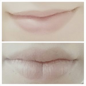 lip fillers before after