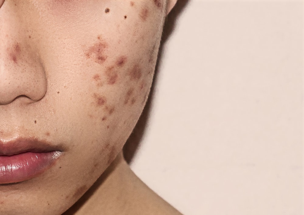 Models with Acne - UK Models